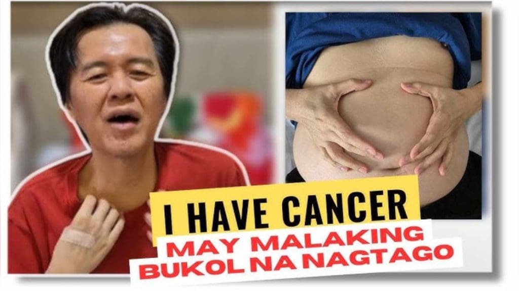 Doc Willie Ong, na-diagnose na may sakit na “very rare” cancer